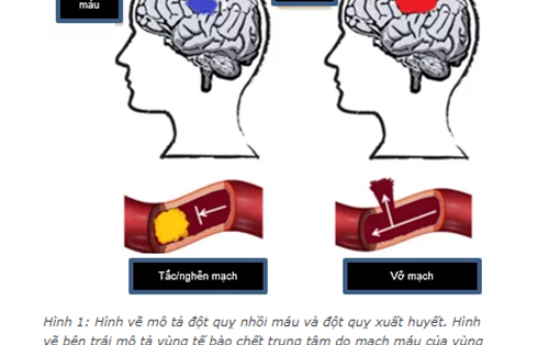 Tiềm năng phòng và điều trị bệnh đột quỵ của Cordycepin